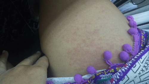 คุณแม่บ้านไหนเป็นผื่นบ้างคะ