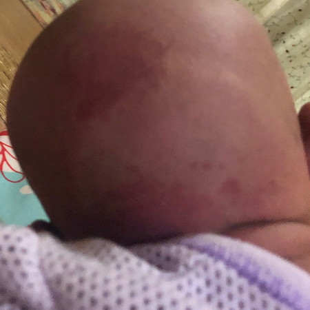 Tompok merah sejak lahir