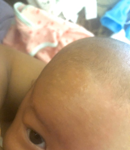 Tompok putih di dahi bayi