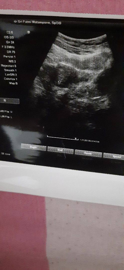 test pack negatif namun ada kantong kehamilan