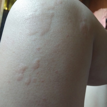 Pernah tak ada ibu2 mengalami elergi pada kulit mcm ni akibat pembawaan bayi ketika hamil?