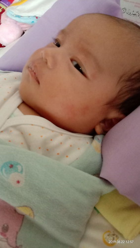 merah di pipi bayi