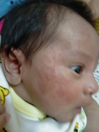 ผื่นแดง