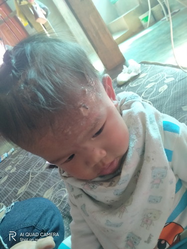 โดนน้ำร้อนลวก