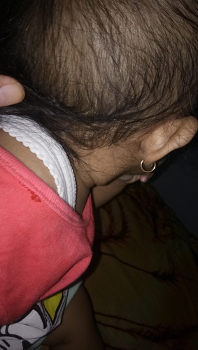 Benjolan di kepala belakang dekat telinga