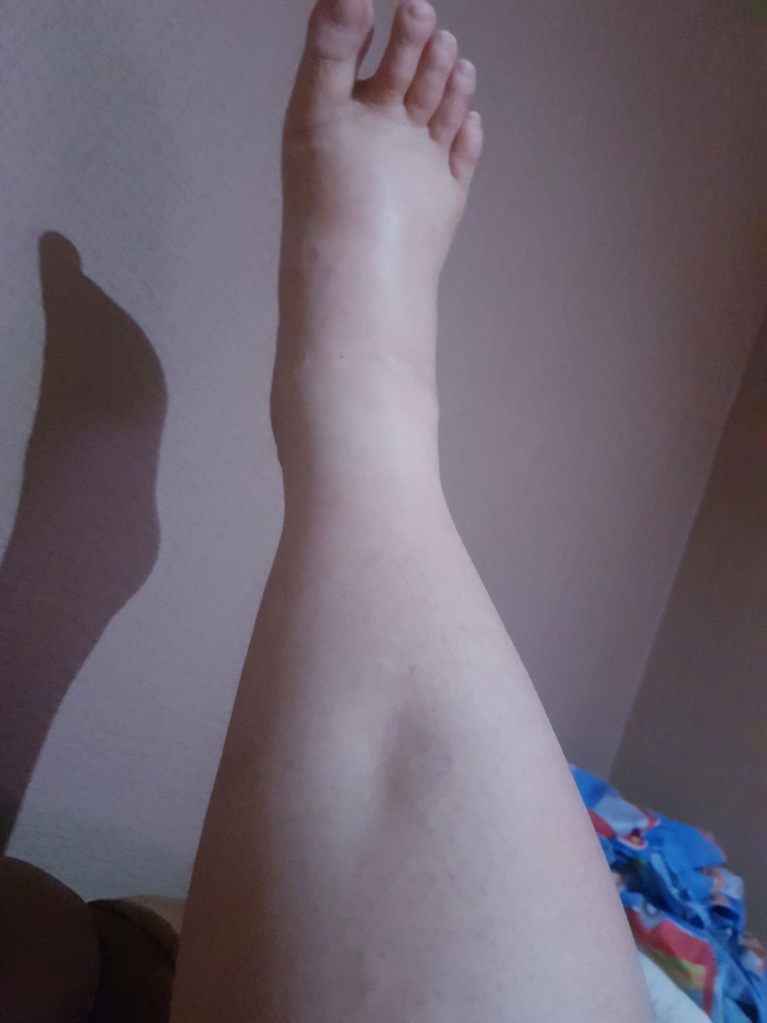 อาการบวมที่เท้า