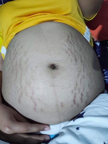 แม่บ้านไหนท้องแตกลายไหมค่ะ