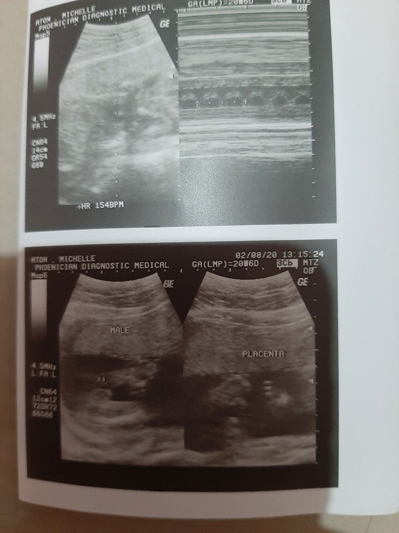 sure na po kaya na baby boy si baby ko?