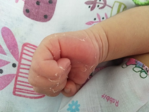 มือลอก