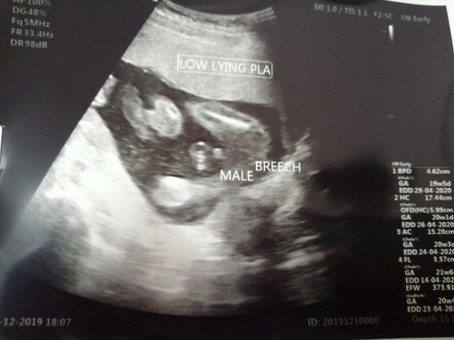 รกเกาะต่ำมีโอกาสที่รกจะขยับไหมคะ