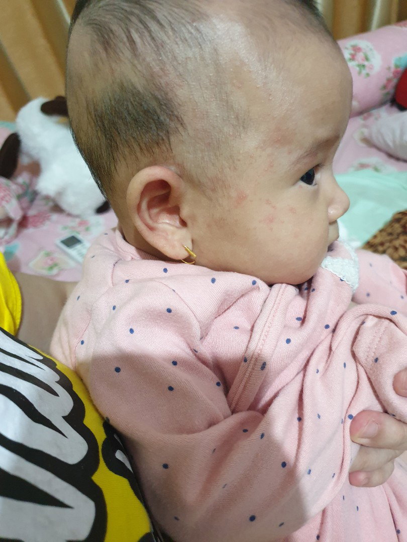 kulit bayi merah bintik bintik