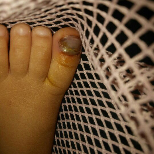 darah beku pada bayi