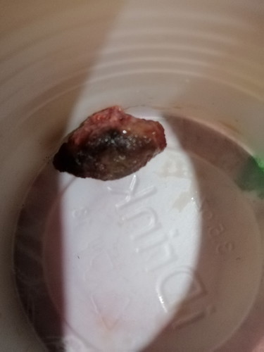 hello po.. ask lang po 2 months po cmula ng makunan aq then parati po sumasakit ang puson q tas may lumalabas sakin na kulay brown. hanggang sa lumabas po ito sakin.. katatapos q lang pong datnan ng dalaw bago yan xa lumabas.. after po lumabas yan hindi