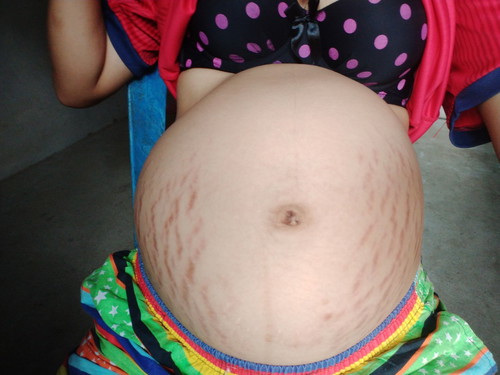 ทำไหมท้องถึงเป็นแบบนี้
