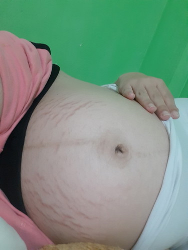 ครีมอะไรทาถึงจางลงแล้วหายบ้าง