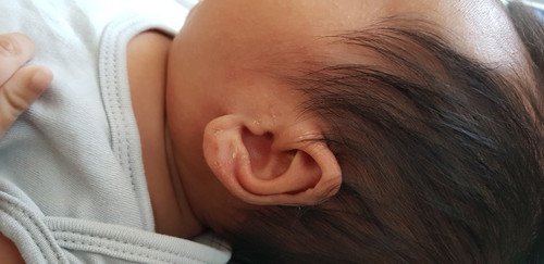 dryness sa skin ni baby