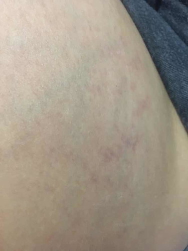 ใครท้องแตกลายบ้างคะ🙋🏻♀️