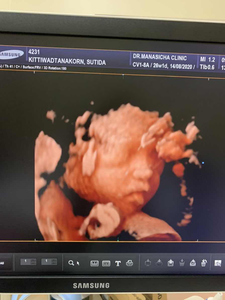 27w แล้ว อีกอีดใจเดียวนะลูก#แฝดสามใบเถาของแม่???ท้องแฝดสามที่ไม่ธรรมดา สู้เพื่อลูก✌️