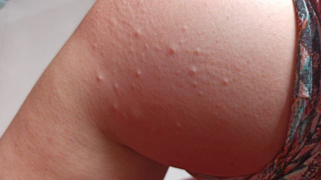 Bumil, ini kenapa yaa?? diperut ditempat lain di bagian tubuh juga begini..