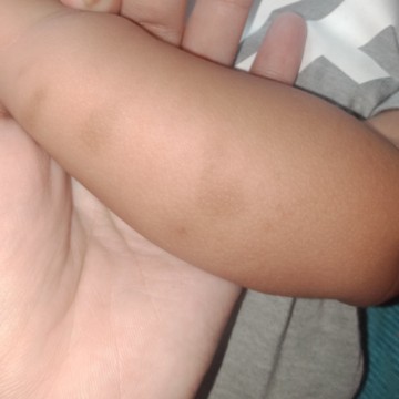 Mosquito bites