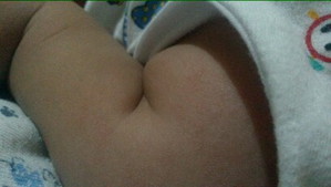 Rashes??