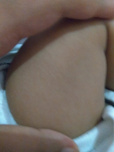 kulit bayi kering