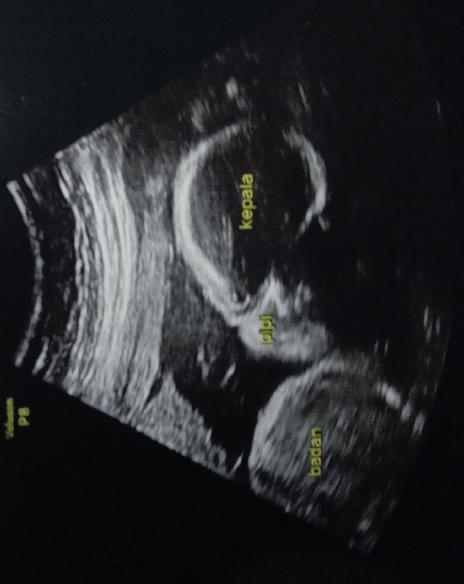 Mau tanya seputar hasil USG 27 week