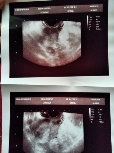 PCOS dan 2 garis merah