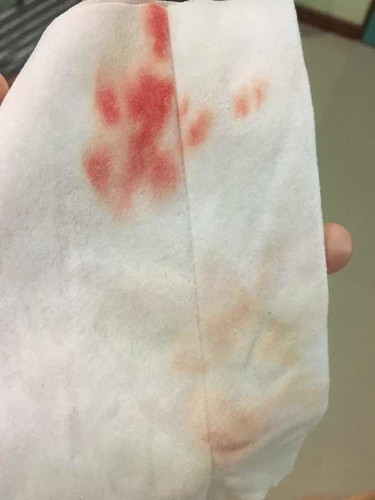 สอบถามหน่อยค่ะ ตอนนี้ 31+6 สัปดาห์ ตื่นมาเข้าห้องน้ำปกติ แล้วมีเลือดออกตามในรูป จะเป็นอันตรายมั้ยคะ มีเลือดแค่ตามรูปนะคะ ตอนนี้ปกติไม่มีเลือดออกแล้ว แต่ช่วงนี้ท้องแข็งเป็นๆหายๆ