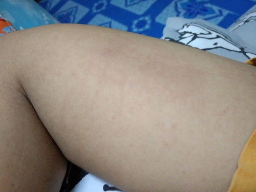 ฝังเข็ม