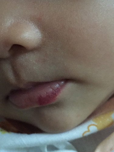 น้องอายุ28วันมีสีแดงขึ้นอยู่ที่ปากคะ