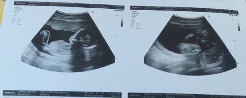 17w