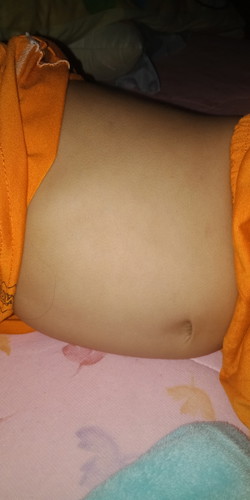 ลูกท้องบวมเคาะมีเสียงเหมือนคนท้องอืดอันตรายมั้ย