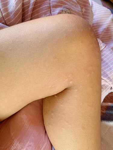 ผื่นหลังผ่าคลอด