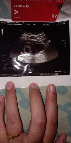 6 weeks pregnancy with ovarian cyst