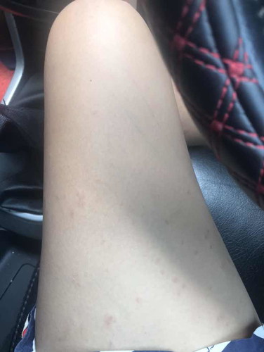 แพ้เพศรักษายังไง