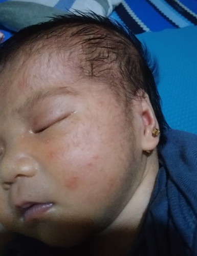 Rashes on my baby's face