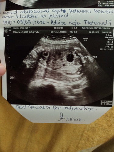 cyst baby