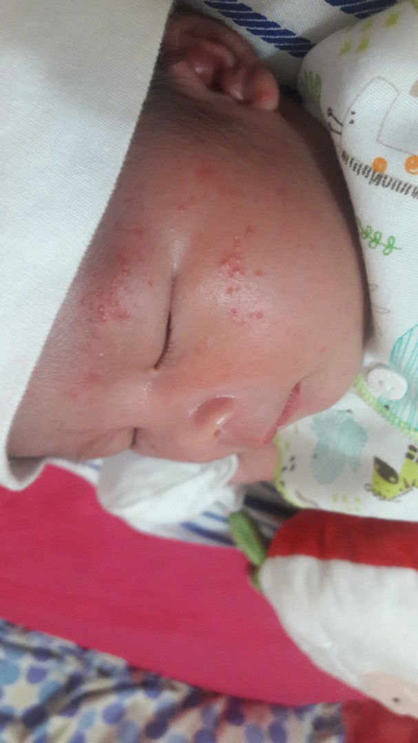 Bintik merah bayi usia 14 hari