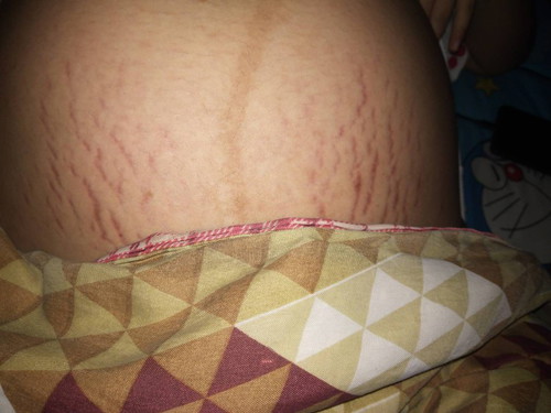 หน้าท้องแตกลาย