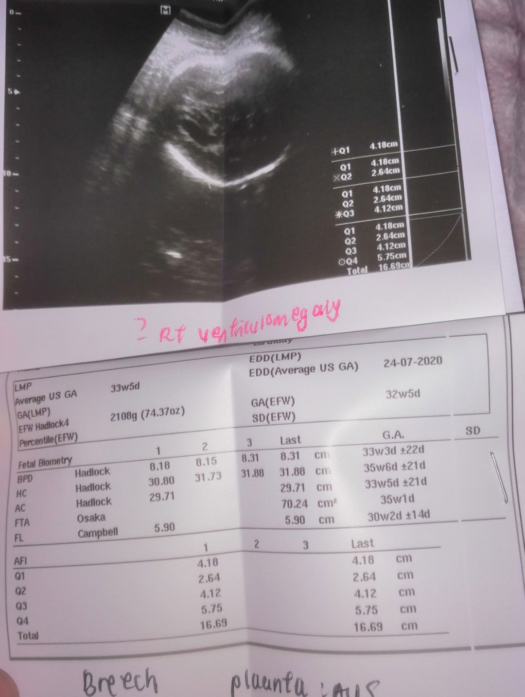 Baby Dlm Kandungan Kepala Besar