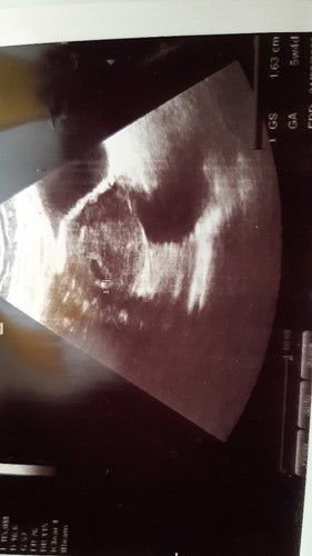 First Pregnancy