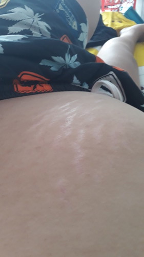 ท้องแตก