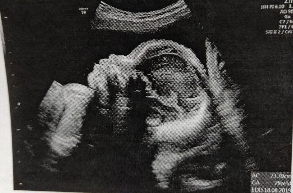 ยังงัยน้ำคร่ำก็ยังเยอะอยู่ดี ?