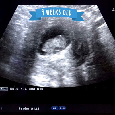 ท้องแรก US มา 9 week แม่ๆท่านอื่นกี่ week กันแล้วคะ