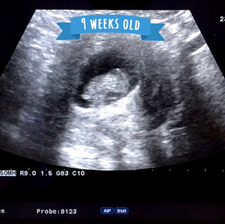 ท้องแรก US มา 9 week แม่ๆท่านอื่นกี่ week กันแล้วคะ