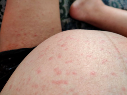 rashes
