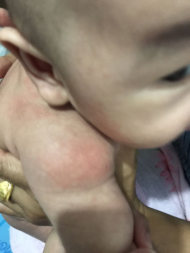 ลูกแพ้นมผงอาการเป็นยังไงคะ