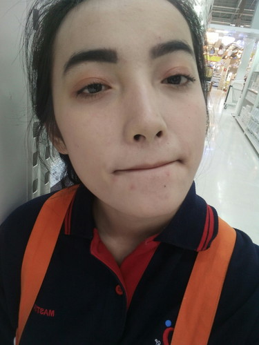 สิวขึ้นจ้า