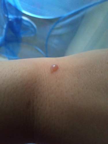 varicella